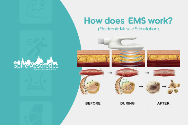 EMS treatment for post pregnancy weight loss treatment Highworth