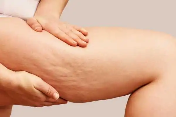 Image of woman showing leg with cellulite Highworth