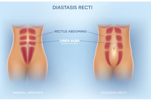 What Non-Surgical Options Are Available for Diastasis Recti Highworth?