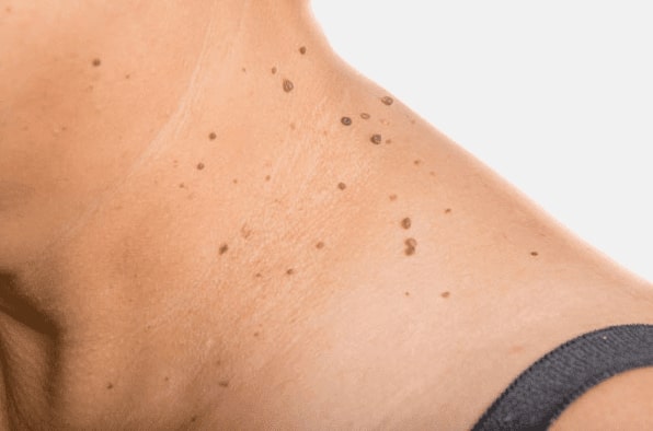 Are you looking for easy skin tag removal Highworth - then contact Spire today!