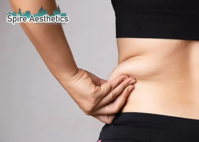 Image of woman pinching fat on their hips Highworth. Fat Freezing treatment