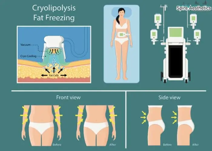 Fat freezing treatment Highworth benefits for competitions to remove stubborn fat deposits.