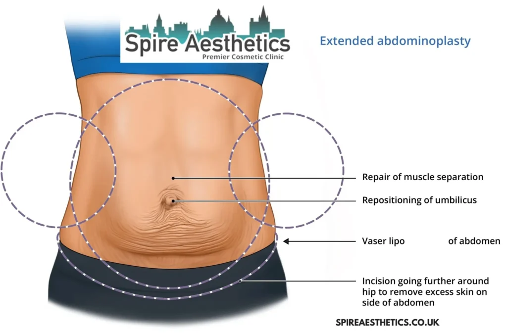 Understanding Loose Skin After Gastric Band Highworth Surgery and HIFU Treatment 
