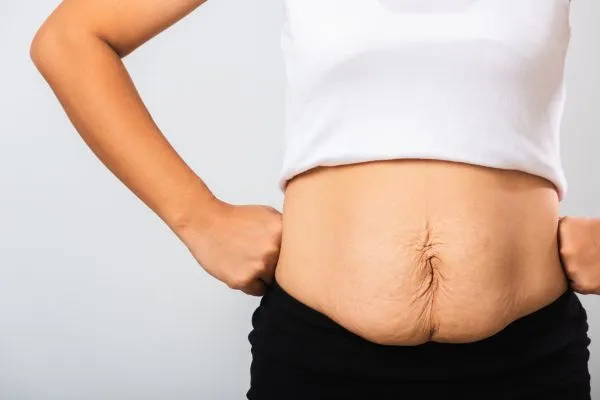 Image of a woman's stomach after weight loss with sagging skin following a gastric band Highworth