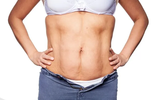 sagging skin on woman's stomach after weight loss injections Highworth