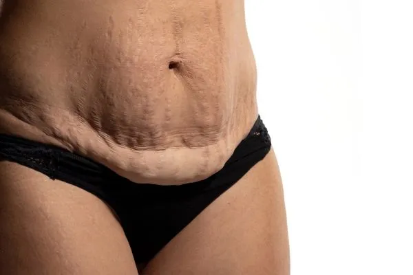 Image of womans stomach after weight loss injections Highworth showing saggy skin
