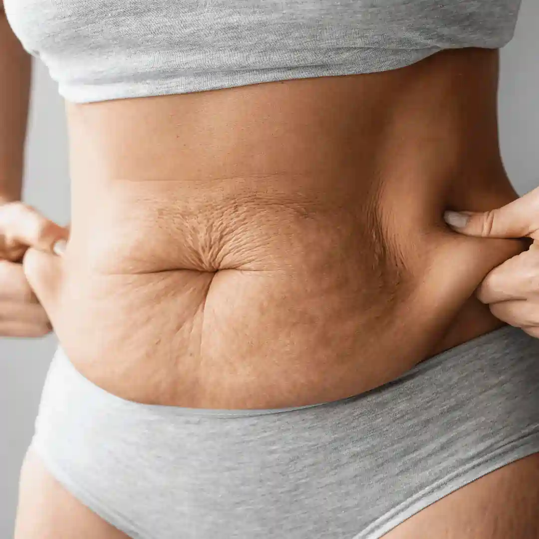 Is It Normal to Have Loose Skin After Pregnancy Highworth?