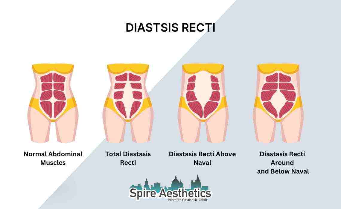 Is Non-Surgical Diastasis Recti Treatment Right for You? Common Concerns Answered Highworth
